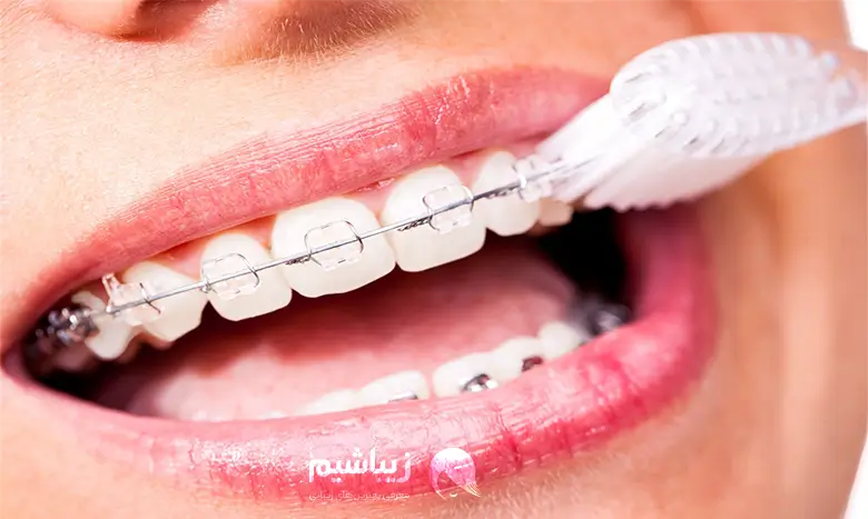 ارتودنسی دندان چه مراحلی دارد
