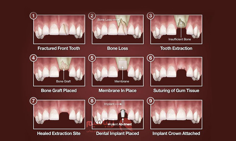 مراحل مختلف کاشت دندان جلو