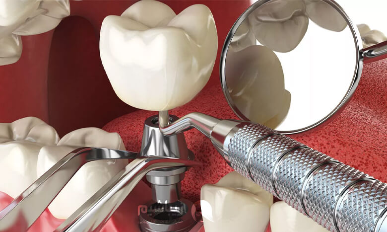 عوارض ایمپلنت دندان چیست