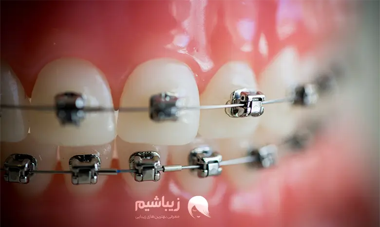 کاربردهای ارتودنسی دندان