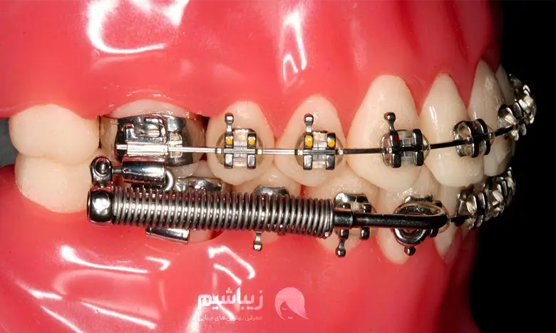 قیمت ارتودنسی دندان با بیمه