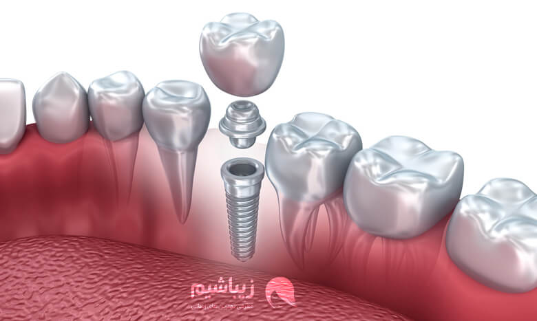 مراحل ایمپلنت دندان چیست