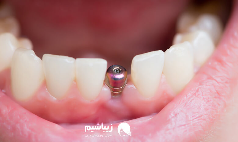اقدامات مهم قبل از ایمپلنت دندان