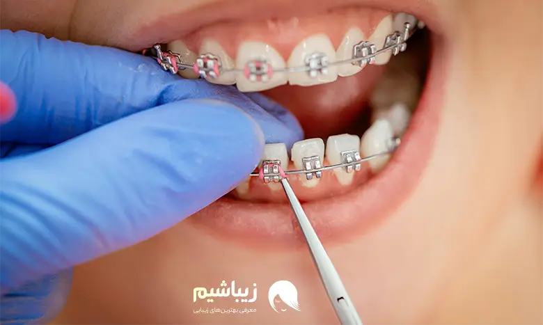 عوامل موثر در هزینه ارتودنسی دندان