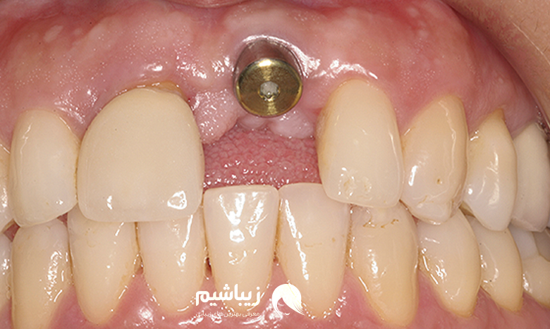 عوارض ایمپلنت دندان، کاهش حجم لثه