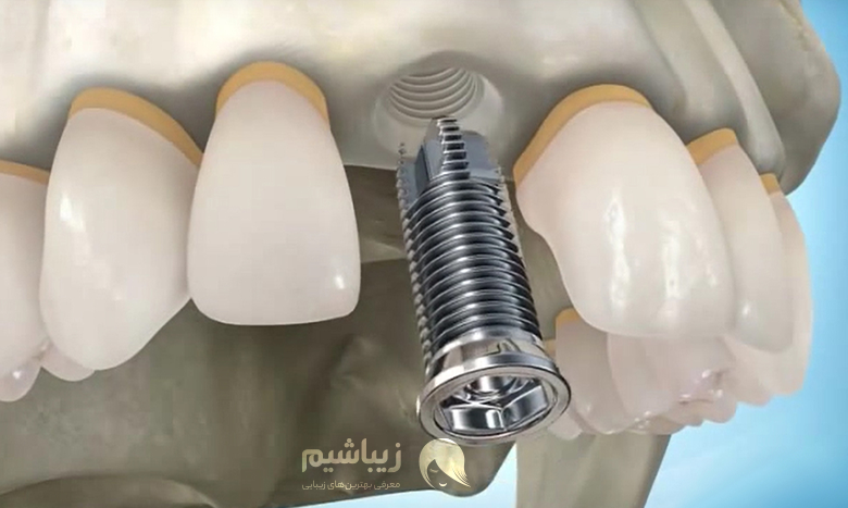 معایب و عوارض ایمپلنت دندان