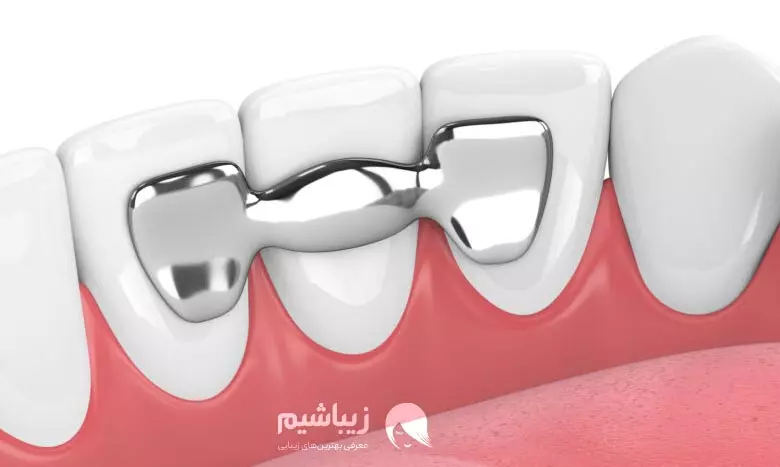 کاشت دندان بدون ایمپلنت چیست