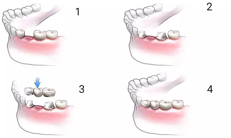 مراحل کاشت دندان بدون ایمپلنت | مراحل کاشت بریج