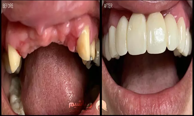 کاشت دندان قبل و بعد