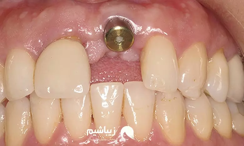 جلوگیری از بروز عوارض ایمپلنت دندان