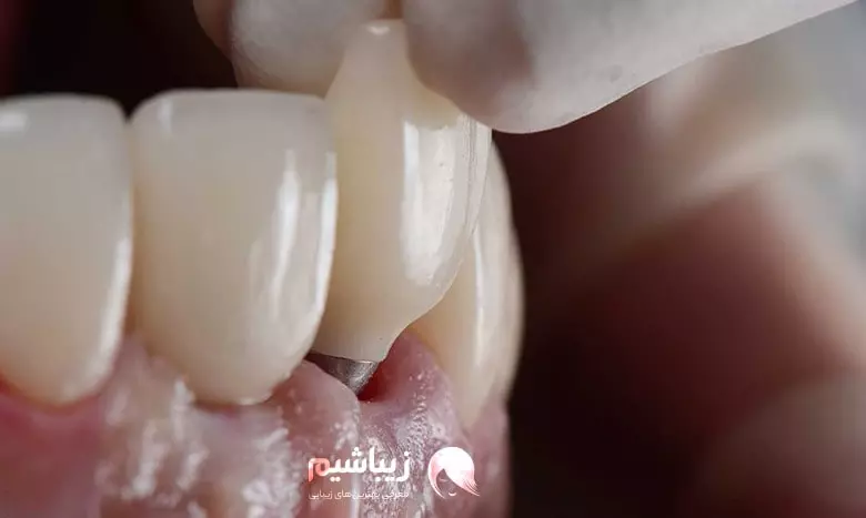 عوارض کمتر شایع ایمپلنت دندان