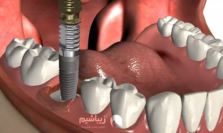 عوارض شایع ایمپلنت دندان