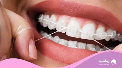 نخ دندان ارتودنسی چیست و نحوه استفاده از آن