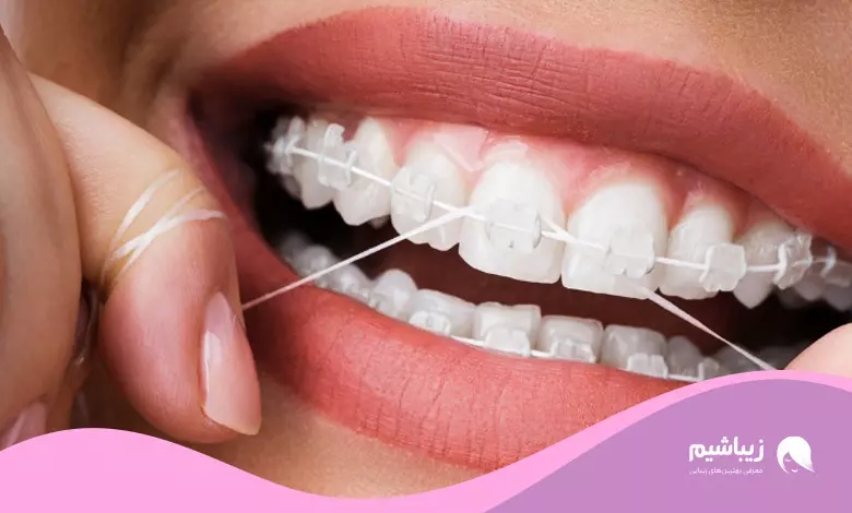 نخ دندان ارتودنسی چیست و نحوه استفاده از آن