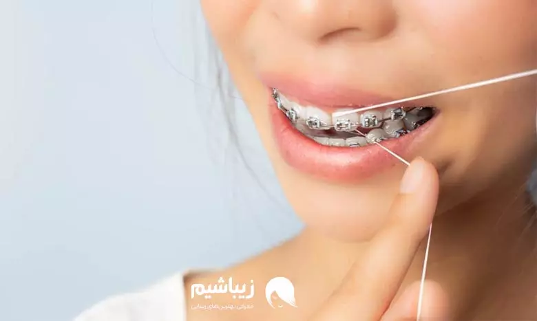 نخ دندان ارتودنسی چیست؟ 