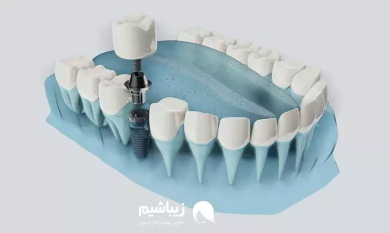 مراحل ایمپلنت دیجیتال دندان
