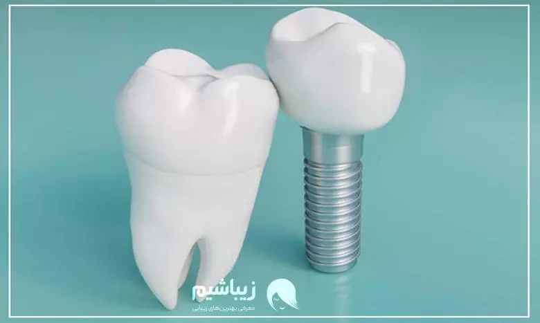 تفاوت جدیدترین روش ایمپلنت دندان و روش های مرسوم
