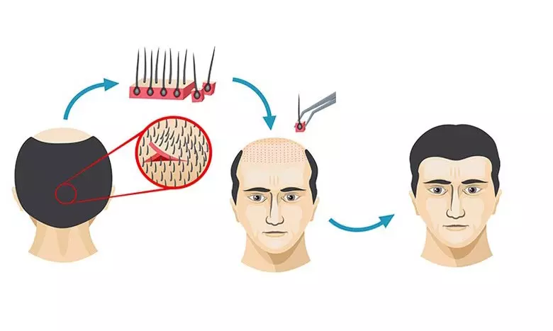 مراحل کاشت مو چیست؟