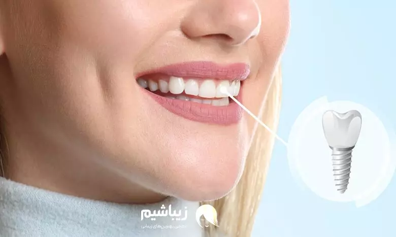ایمپلنت دندان یکی از روش های اصلاح طرح لبخند است.