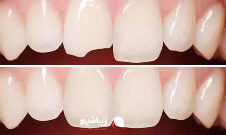 روش های ترمیم دندان شکسته چگونه است؟